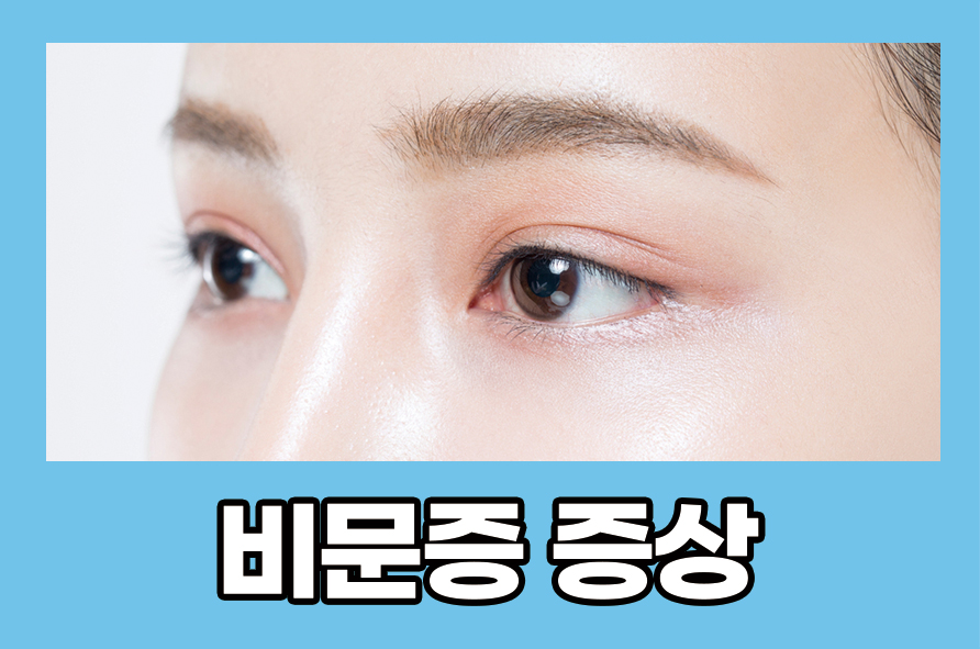 비문증증상 날파리증 원인은 무엇일까? 관련 이미지 1