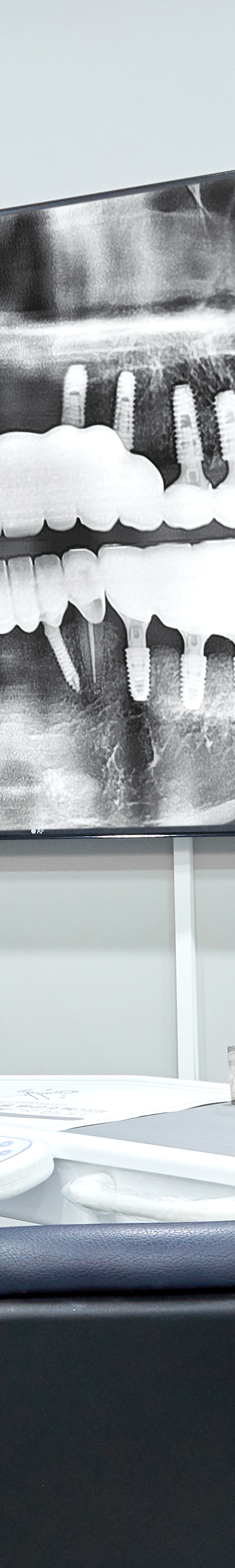 Treatment That Reduces Burden Through Conscious Sedation for Sinchon Dental Implants image 34