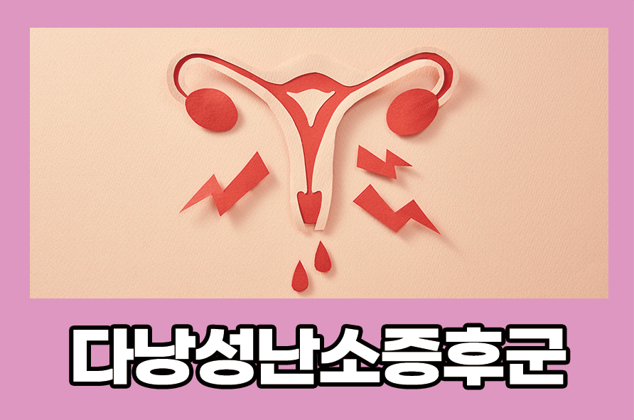 다낭성난소증후군 완치하려면 적합한 치료법은? 관련 이미지 1