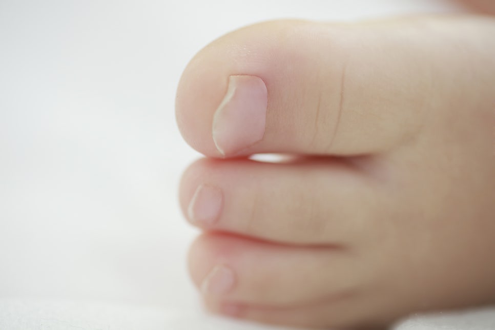 Causes of Toenail Bruising, Related Conditions, and Prevention image 2