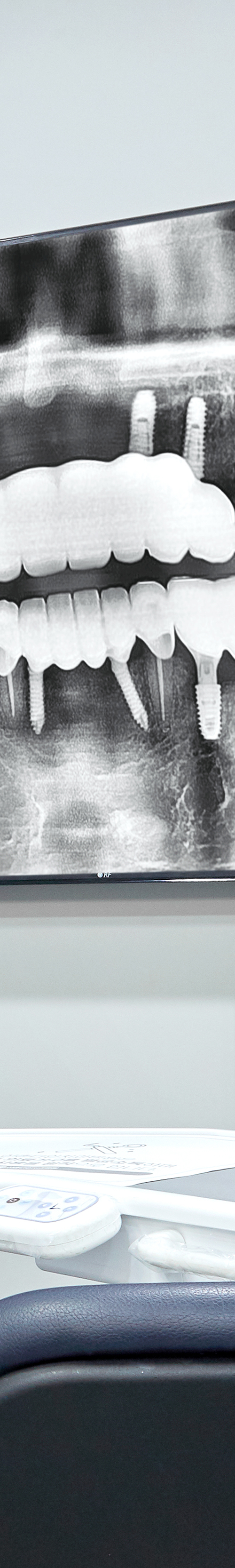 Hapjeong Station Dental Clinic Implant Treatment Through an Appropriate Treatment Plan image 44