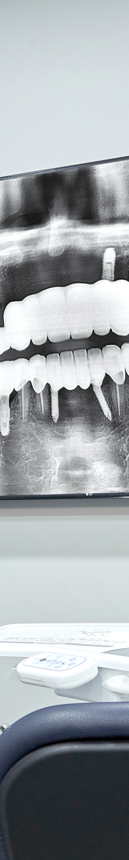 Shinchon Dental Implant Placement and Careful Aftercare image 40