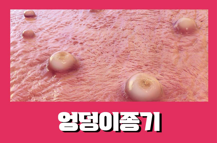 엉덩이종기 생기는 이유와 예방법에 대해서 관련 이미지 1