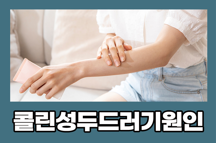 What Causes Cholergic Urticaria, Its Symptoms, and How to Prevent It image 1