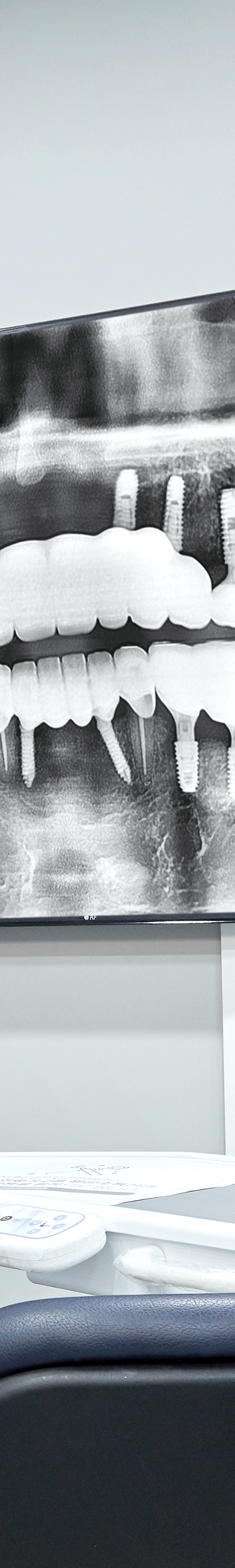 Yangpyeong-dong Dental Clinic: Treatment That Eases Concerns About Implant Procedures image 44