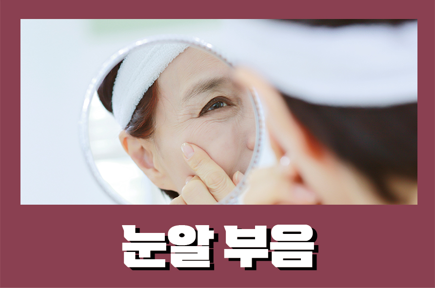 눈알부음 결막염 증상일 수 있으니 주의하자 관련 이미지 1