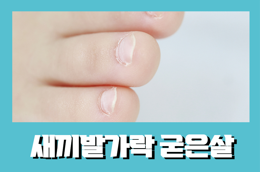새끼발가락굳은살 생겼다면 소건막류 의심을 관련 이미지 1