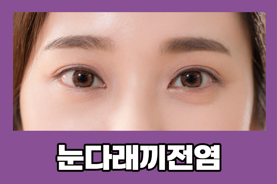 눈다래끼전염 증상 관리 방법으로는 관련 이미지 1