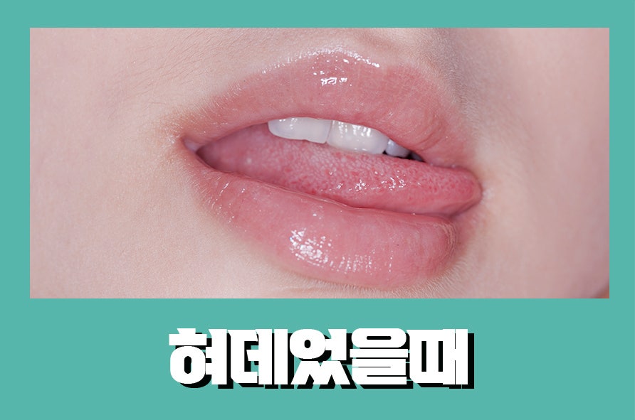 혀데었을때 응급조치가 중요해요 관련 이미지 1