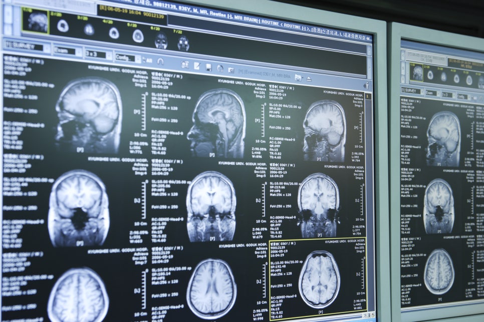 Warning Signs of Cerebral Infarction: Acute Causes, Headache Test, Treatment, and Response Measures image 5