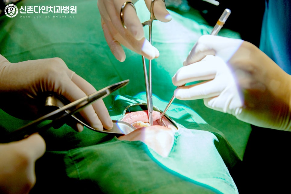 To Achieve Both Function and Aesthetics with Implant Placement at Sangam Dental Clinic image 7