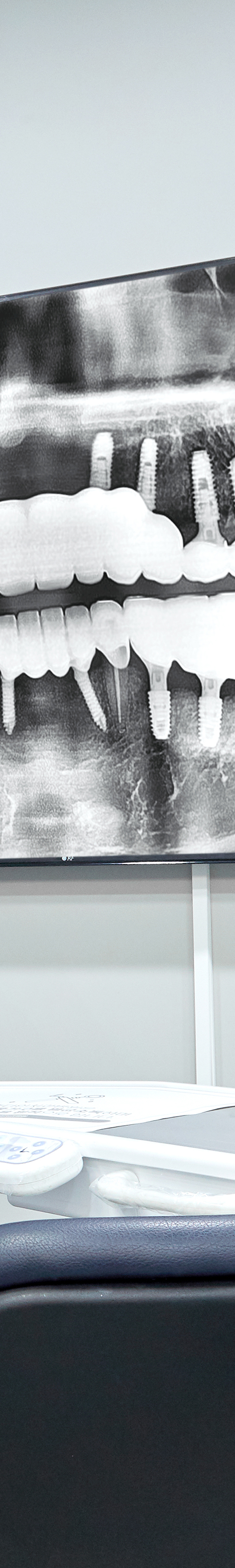 Yeouido Dental Clinic: Implant Treatment Period Depends on the Patient's Condition image 44