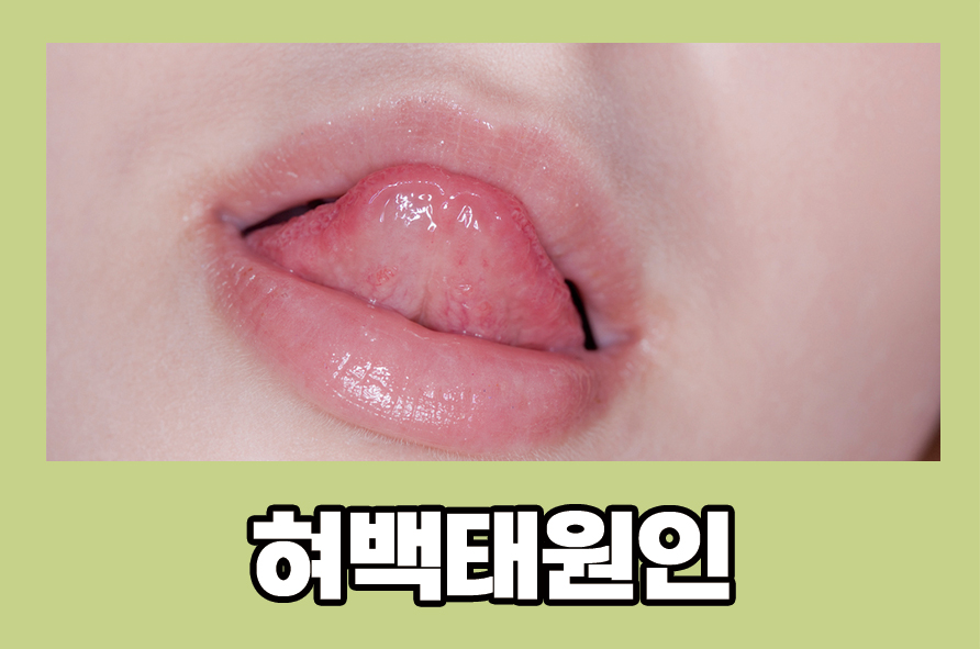 Causes of Tongue Coating and How to Care for Your Tongue image 1