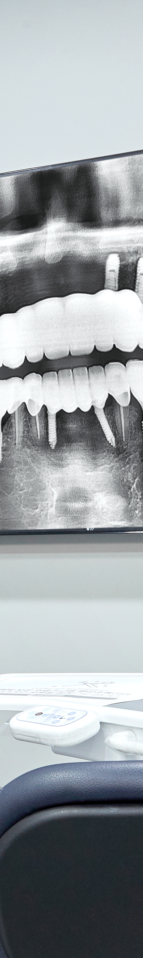 Shinchon Dental Implant Procedure Through an Individualized Plan image 34