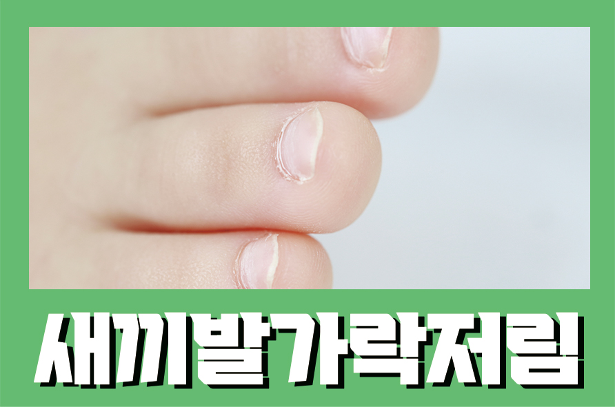 새끼발가락저림 구두를 자주 신는 여성들에게 많이 발생하는 관련 이미지 1