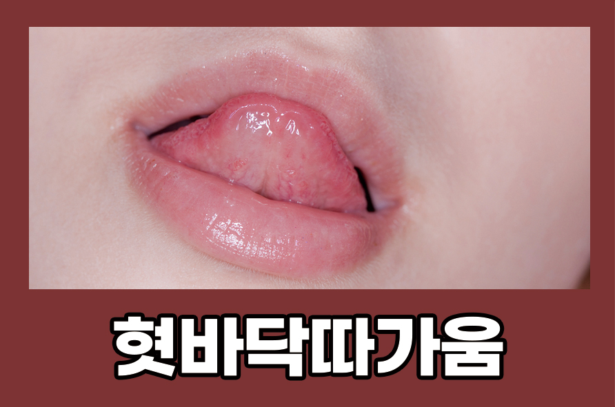 혓바닥따가움 원인과 증상 예방법에는 관련 이미지 1