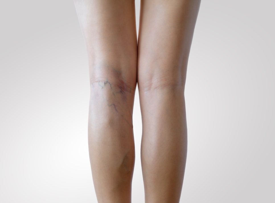 자반증 아이 노인 증상, 원인 치료 예방 음식은? 관련 이미지 4
