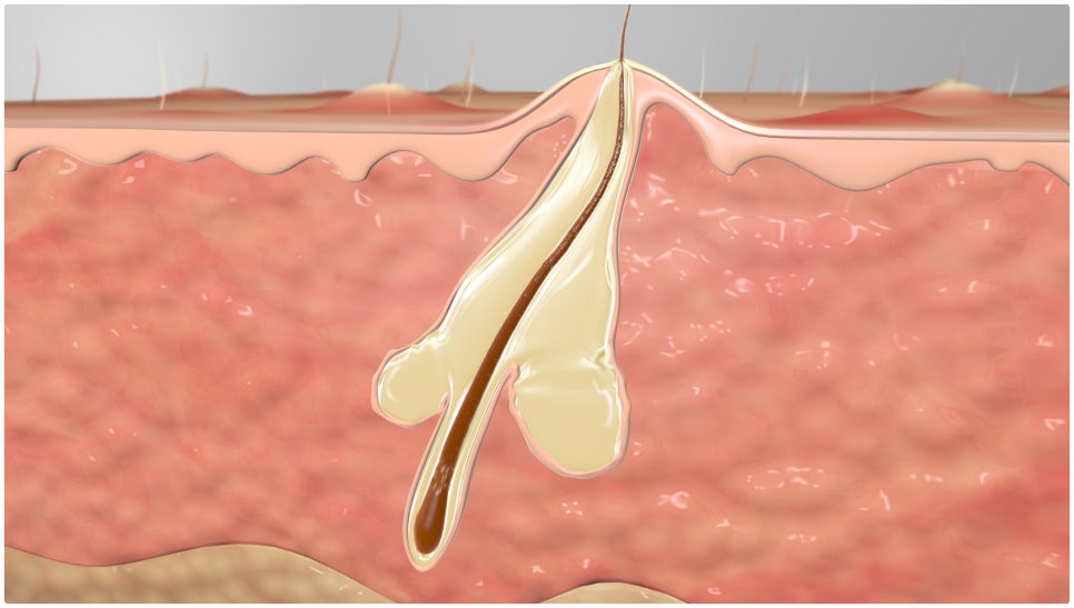 Seocho-gu Acne Treatment with a Method Based on Your Condition image 5
