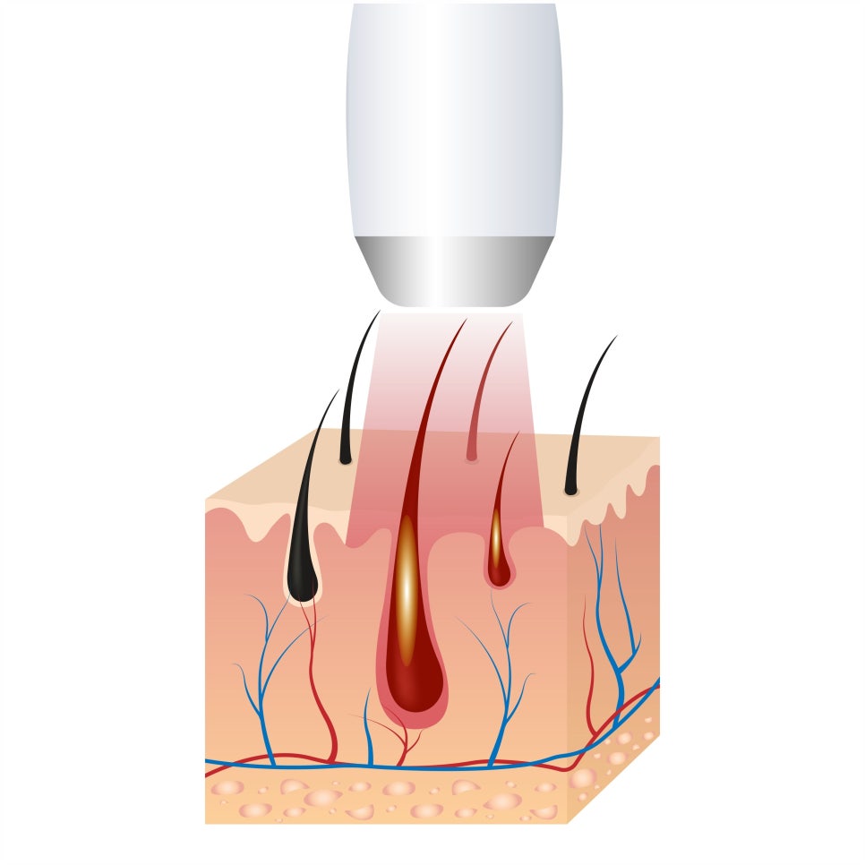 Sadang Station Male Laser Hair Removal with the New GentleMax Pro Plus image 4