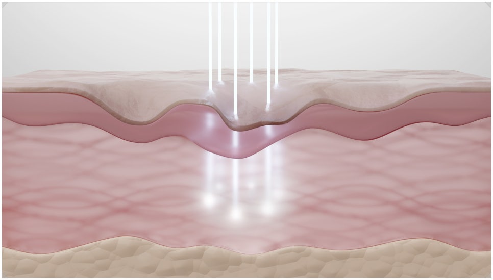 Banpo-dong Ulthera Prime: How Is the Upgraded Device Different from the Existing Ulthera? image 3