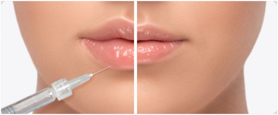 Bangbae-dong Lip Filler for Naturally Enhancing Volume image 1