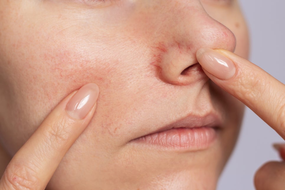 Bangbae-dong Vbeam: Rosacea Treatment at Greeny Dermatology! image 3