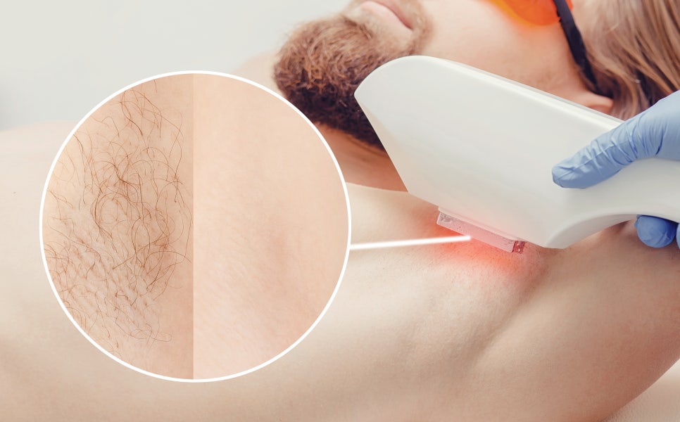 Seocho-gu Sunday Dermatology Clinic: A Neat Impression Through GentleMax Pro Plus Laser Hair Removal image 2
