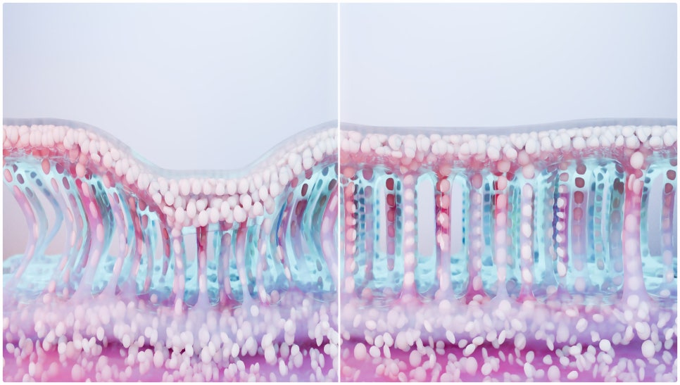 If the elasticity in Seocho-gu Ulthera Prime has noticeably sagged image 2