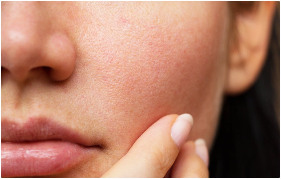 Seocho-gu Vbeam, a Choice for Treating Facial Redness image 5