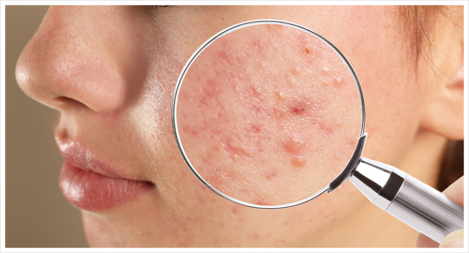 How to Respond Early to Acne Scars in Seocho-gu image 2