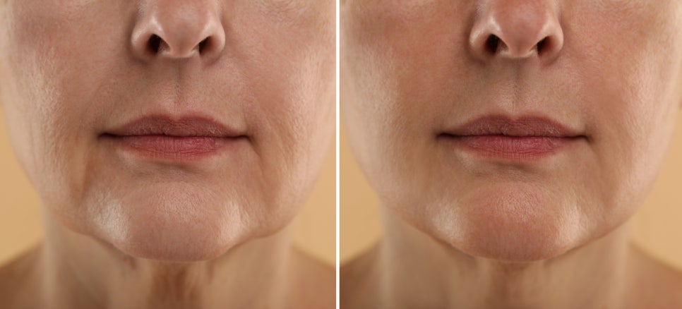 Skin Botox Near Sadang Station, Before Wrinkles Set In image 1