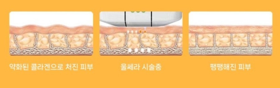 울쎄라 유지기간 300샷 600샷 차이까지 관련 이미지 5