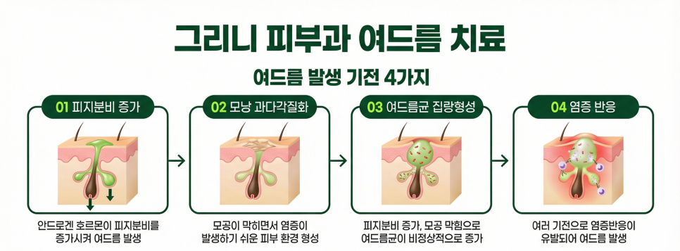 여드름이 계속 나는 이유, 치료해도 반복되는 이유는? 관련 이미지 2