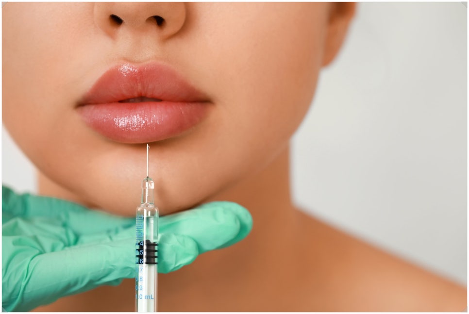 Bangbae Station Lip Filler: Natural and Full of Volume image 2