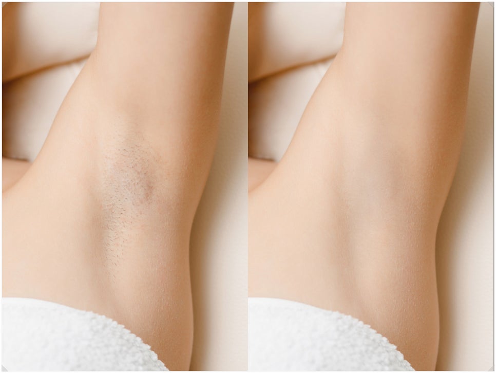 Thorough Care for Seochogu GentleMax Hair Removal, from Results to Pain Management image 4