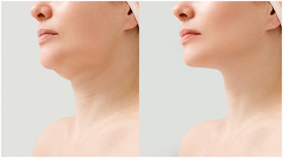 Isu Station Onda Lifting: Reducing Fat While Preserving Facial Contours image 4