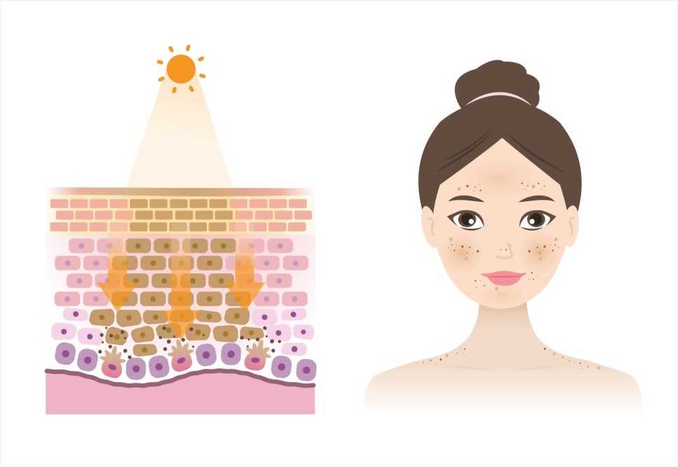 방배동기미레이저 사람마다 결과가 다른 이유는? 관련 이미지 3