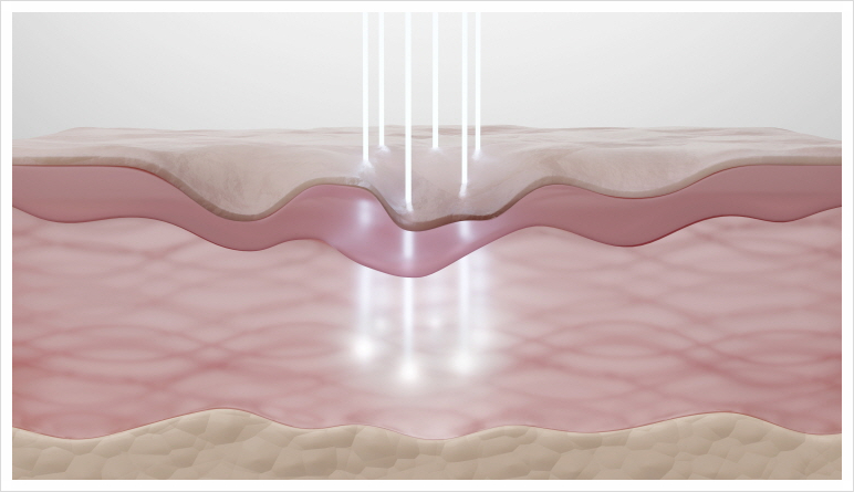 Ishu Station Sunday Dermatology, Is Ulthera Prime a Procedure I Need Too? image 2
