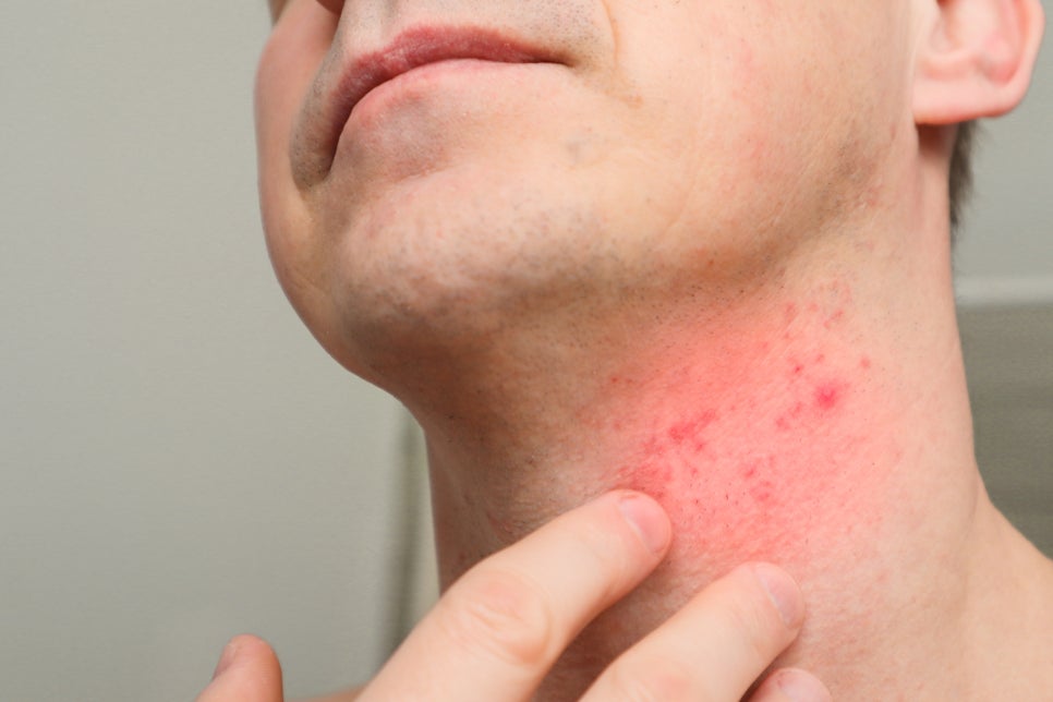 Seocho-gu Sunday Dermatology Clinic: A Neat Impression Through GentleMax Pro Plus Laser Hair Removal image 4