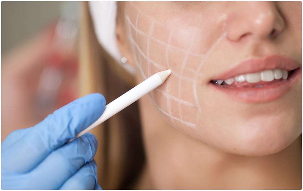 Reliable Nasolabial Fold Filler in Seocho-gu image 3