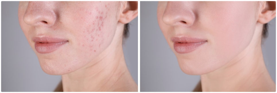 Potenza at Sadang Station: Is This Treatment Suitable for My Skin Concerns? image 1
