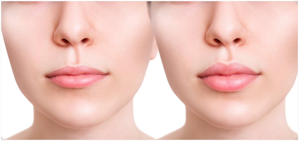 Bangbae Station Lip Filler: Natural and Full of Volume image 5