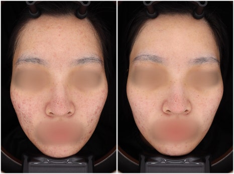 If You Are Feeling Stressed About Acne Treatment in Bangbaedong image 8
