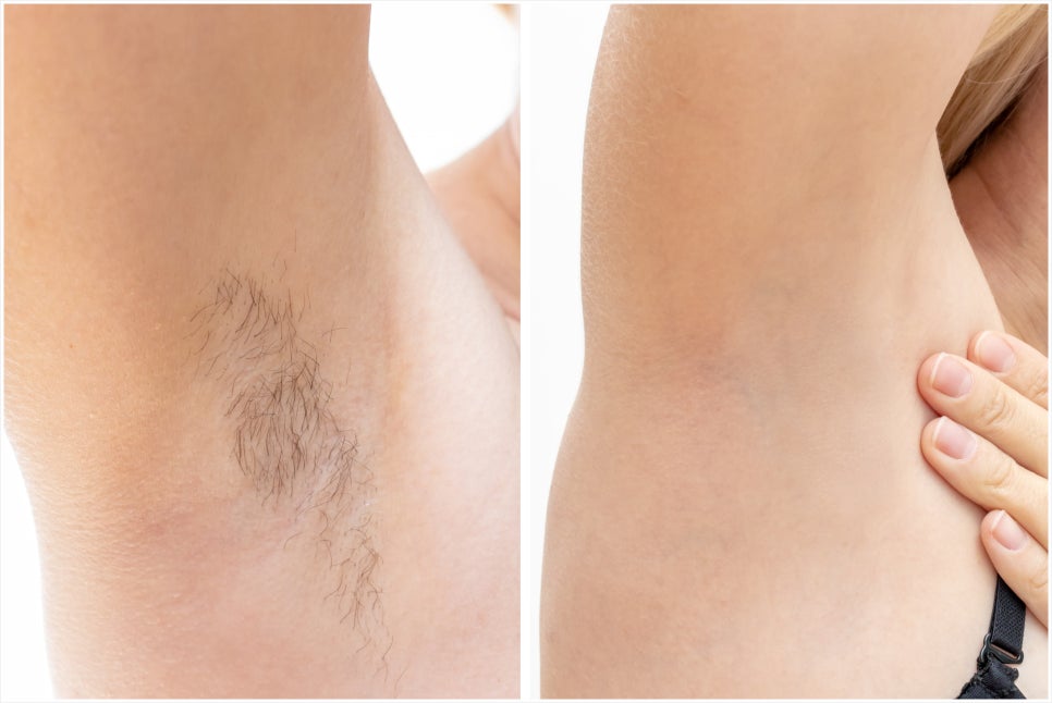 Laser Hair Removal in Seocho-gu: If Dark Stubble Is Bothering You image 3