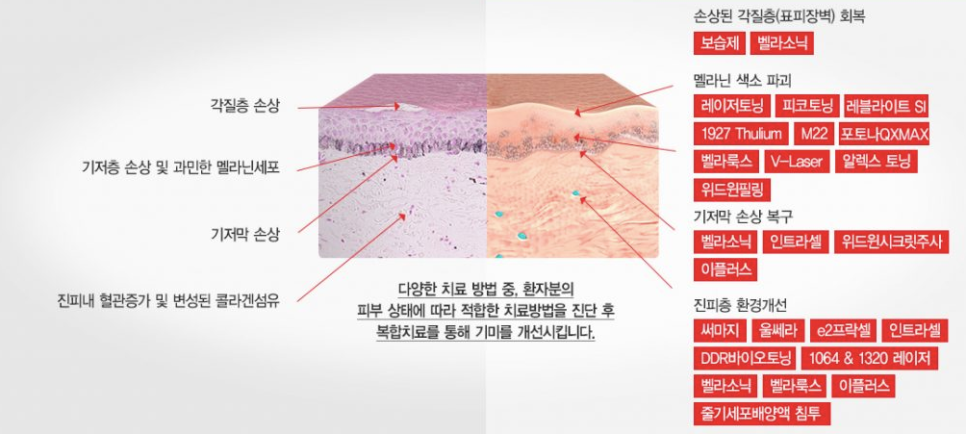 방배동레이저토닝 투명한 피부를 위해 관련 이미지 7