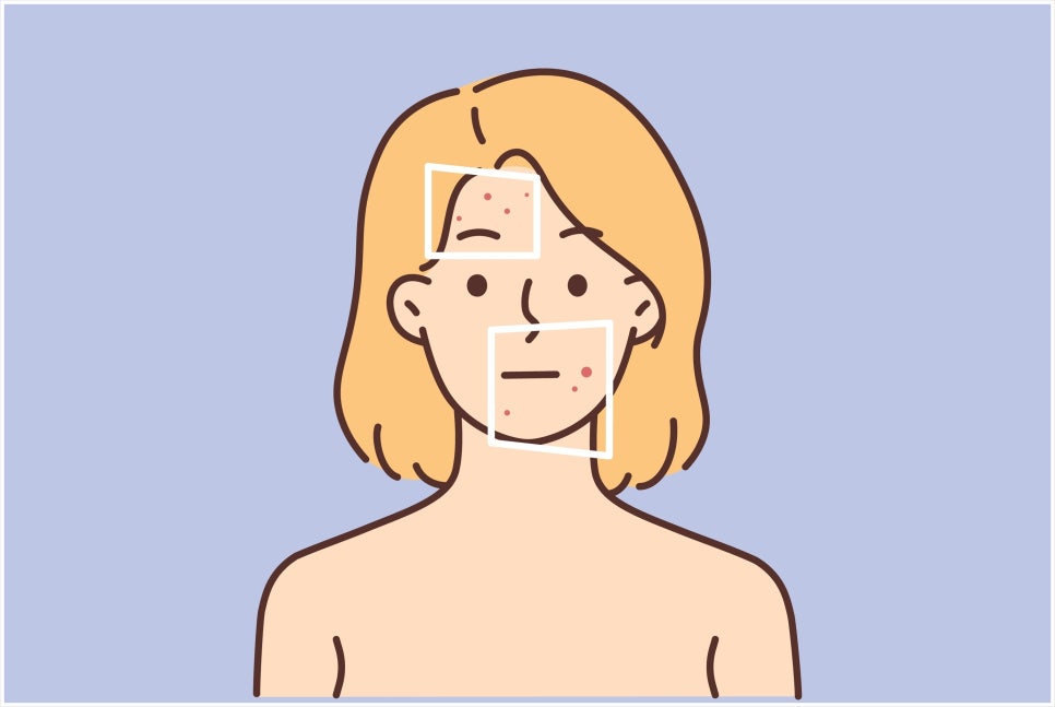 How to Respond Early to Acne Scars in Seocho-gu image 1