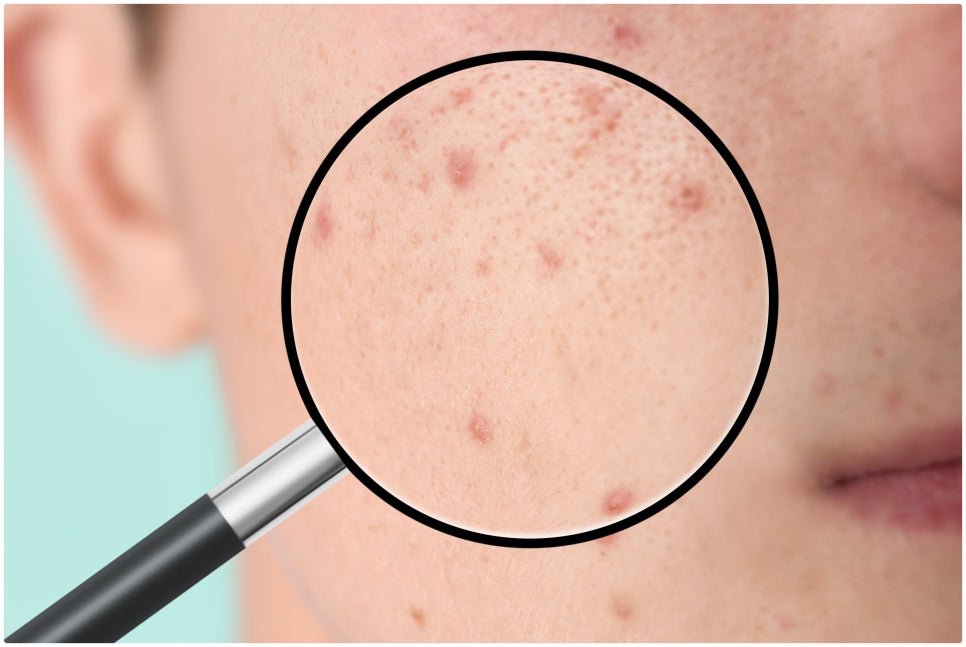 Potenza at Sadang Station: Is This Treatment Suitable for My Skin Concerns? image 5