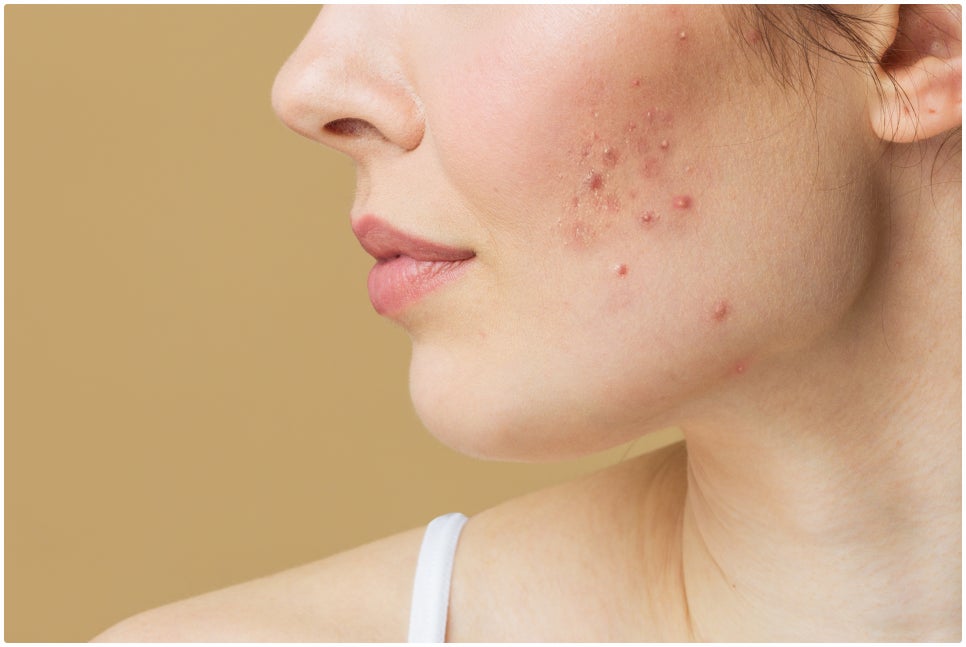 If You’re Stressed by Acne Scars at Sadang Station CUREJET image 3