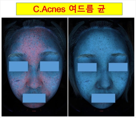 If You Are Feeling Stressed About Acne Treatment in Bangbaedong image 11
