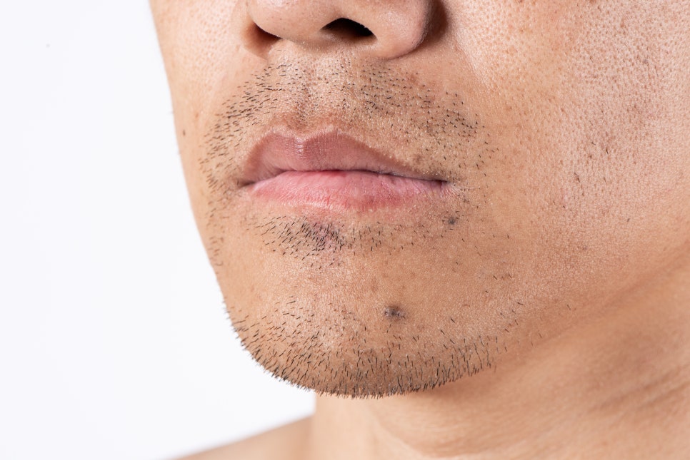 Seocho-gu Sunday Dermatology Clinic: A Neat Impression Through GentleMax Pro Plus Laser Hair Removal image 3